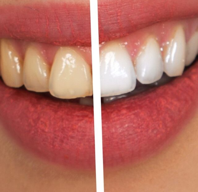 The Top 5 Teeth Whiteners For Sensitive Teeth