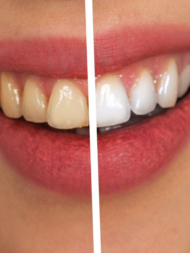 The Top 5 Teeth Whiteners For Sensitive Teeth